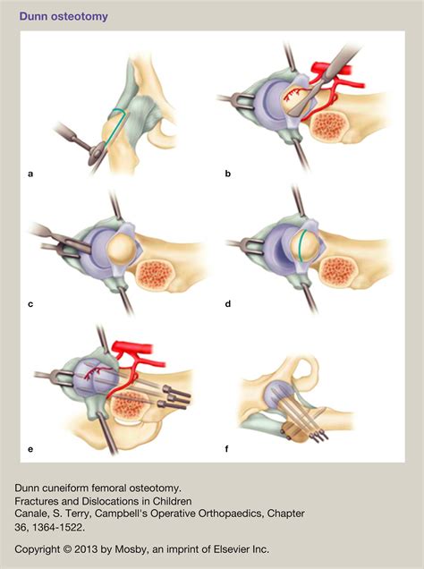 Slipped upper femoral epiphysis - Surgery - Oxford International Edition