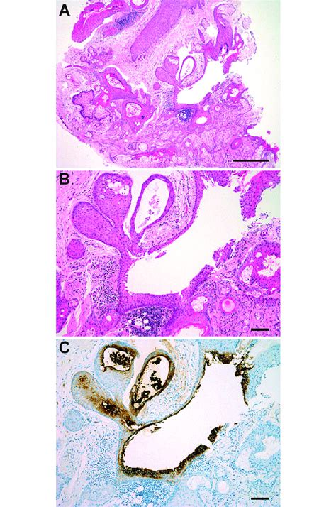 Histopathological Examination Of The Removed Tumor A Lowpower View Of