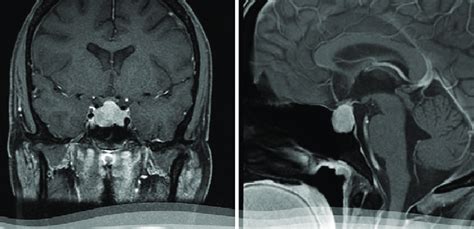 Initial MRI of the pituitary was performed because of pituitary... | Download Scientific Diagram