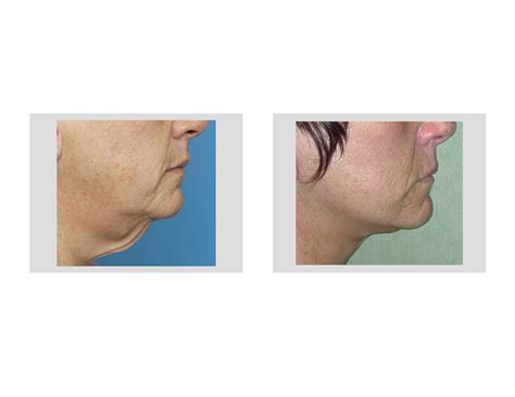 Necklift Indianapolis Dr Barry Eppley Explore Plastic Surgery