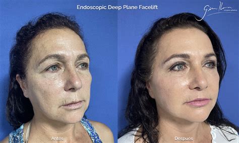 Pre Y Post Endoscopic Deep Plane Facelift Lifting Facial De Planos