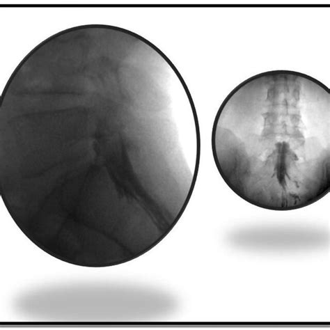 Fluoroscope Verification Of Contrast Spread At L4l5 Download Scientific Diagram