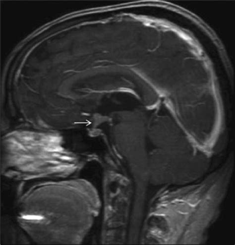 Sagittal Contrast Enhanced T1 Weighted Mr Image Shows The Infiltration