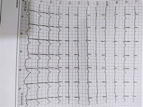 Interpretacja Ekg Kardiologia Kardiolo Pl