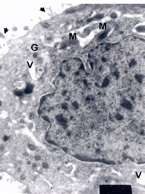 Electron Micrograph Of Human Endometrium Of Rpl Group Showing Higher