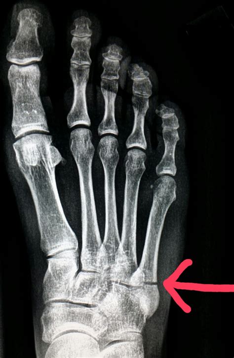 Xray Broken Foot