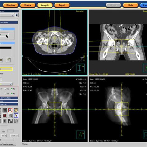 A Photo Of Philips Brilliance Big Bore Ct Scanner Philips Medical Download Scientific Diagram