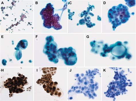 Primary Peritoneal High Grade Serous Carcinoma Misinterpreted As Metastatic Breast Carcinoma A