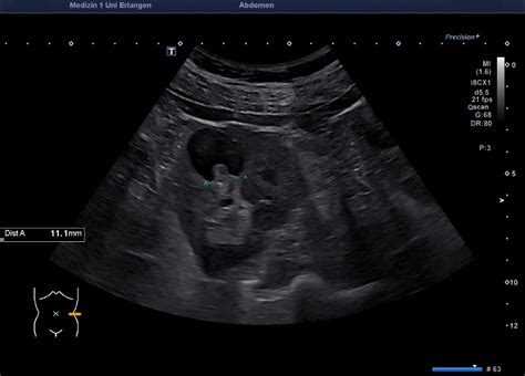 Complicated renal cyst – Atlas of Ultrasound