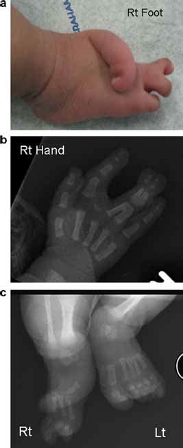 Unilateral Split Handfoot Malformation Of Right Hand And Foot With