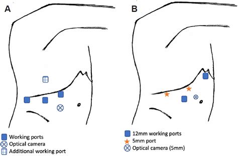 Patient And Port Positioning In Laparoscopic Liver Resections