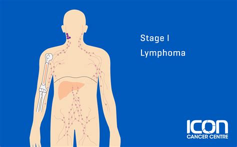 Lymphoma Cancer Types, Signs, Symptoms & Stages