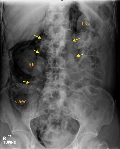 Retroperitoneal Perforation Radiology At St Vincents University