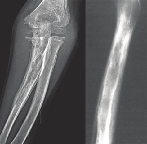 A B Linear Periosteal Reaction Osteomyelitis A Sickle Cell Anemia