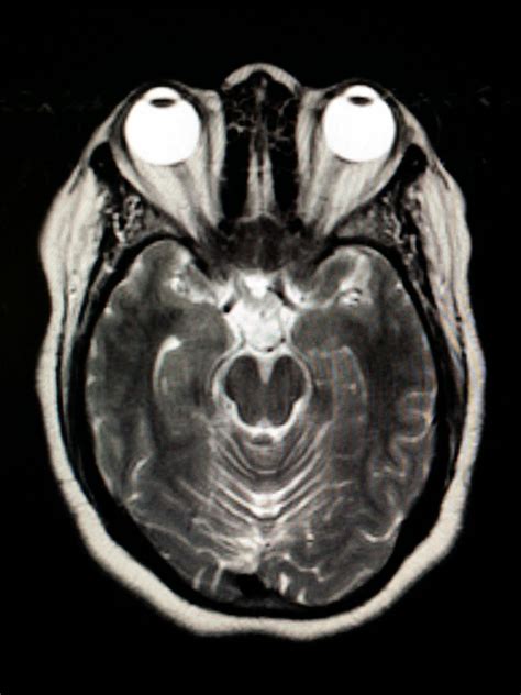 Axial Head Mri Scan