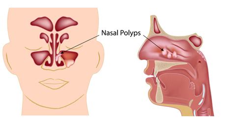 Sinusitis, Balloon Sinuplasty, Image-guided Sinus Surgery, Functional Endoscopic Sinus Surgery ...