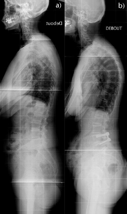 Preoperative And One Year Postoperative Radiographs Of L L