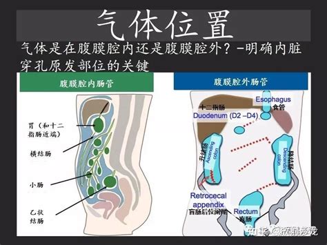 胃肠穿孔：气从哪里来？通过腹膜解剖确定穿孔部位 知乎