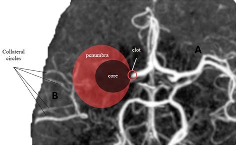 Core Penumbra Ratio Under Different Collateral Circles Condition A