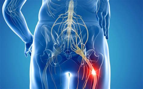 How Acupuncture Works For Sciatica Pain Institute Of Sports And Spines