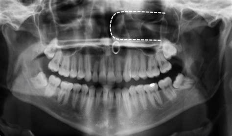 Head And Neck Structures Seen On Radiographs Exam2 Flashcards Quizlet