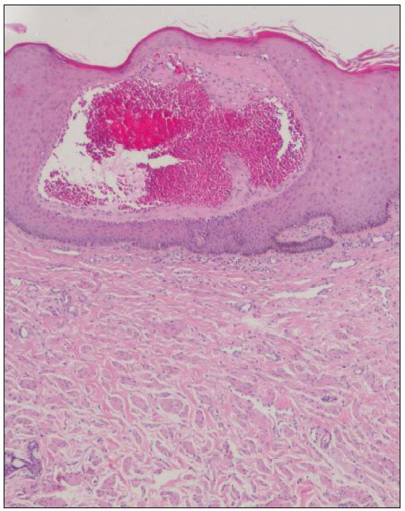 Refractory Angiokeratoma Of Fordyce A Manifestation Of Pelvic Arteriovenous Malformations