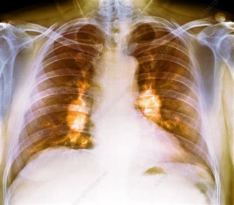 Sarcoidosis of the lungs, X-ray - Stock Image - C038/7671 - Science ...