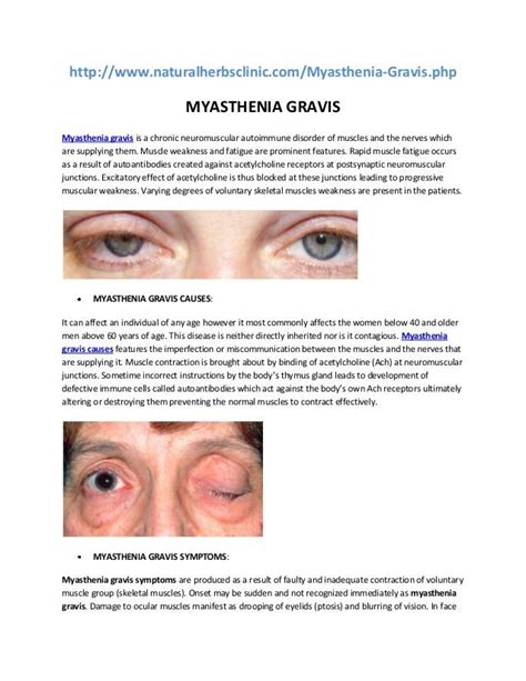 Myasthenia Gravis Diagram