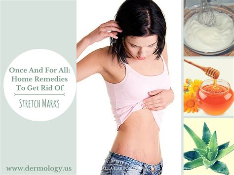 Once And For All Home Remedies To Get Rid Of Stretch Marks An Infographic