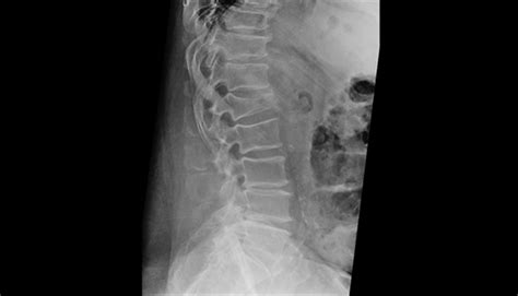 Lumbar Fracture X Ray