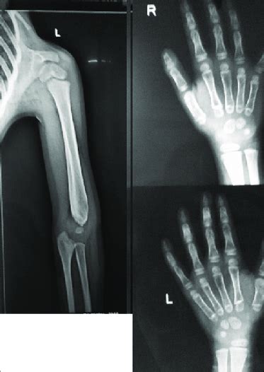 X-ray of left arm and forearm showed fracture of distal end of left ...