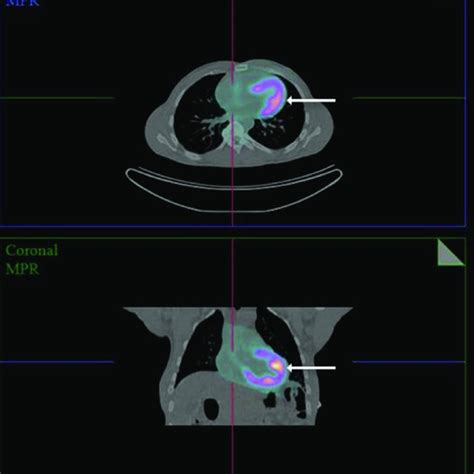 F Fluorodeoxyglucose Positron Emission Tomography Ct Showing Diffuse