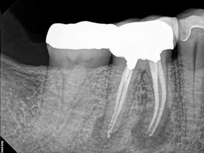 Periapical Radiolucency