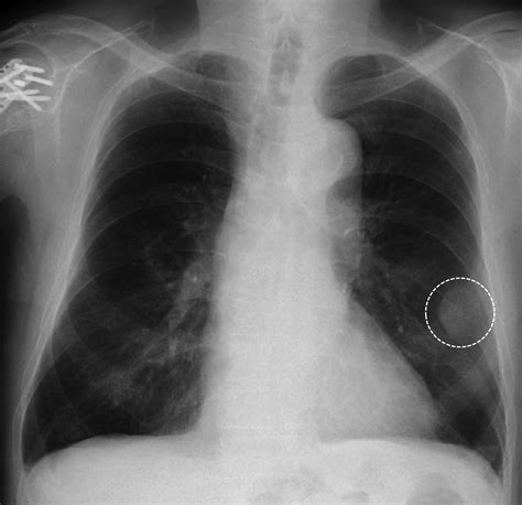 Solitary Costal Plasmacytoma Mimicking Lung Cancer Metastasis Kadota