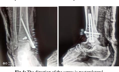 Figure 1 From Functional And Radiological Outcome Of Orif In