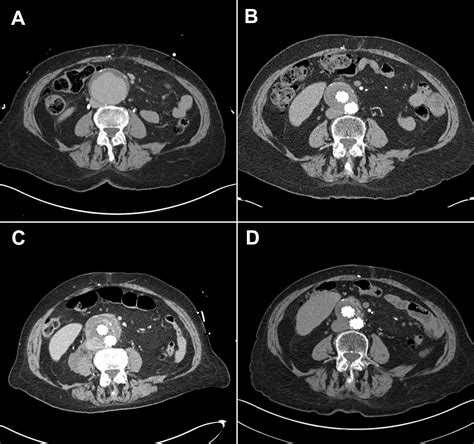 Recanalization Of Previously Thrombosed Type Ii Endoleak With Aneurysm