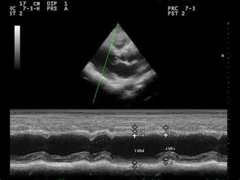 Case Echo Left Bundle Branch Block Lbbb Youtube