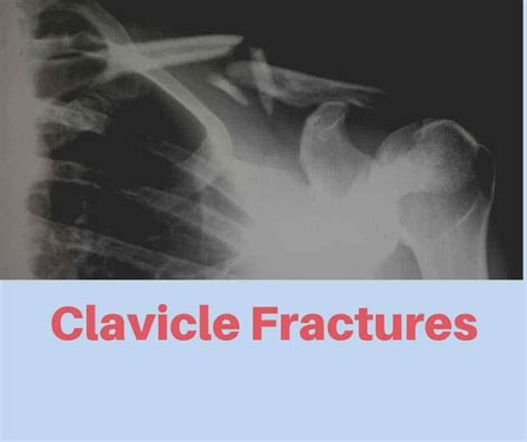 Clavicle Fracture Treatment London Shoulder Elbow Surgeon