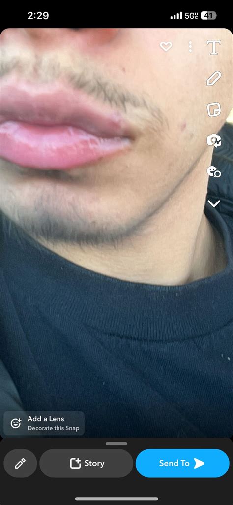 Got this bump on my lip a couple days ago how do you treat this ? Also ...