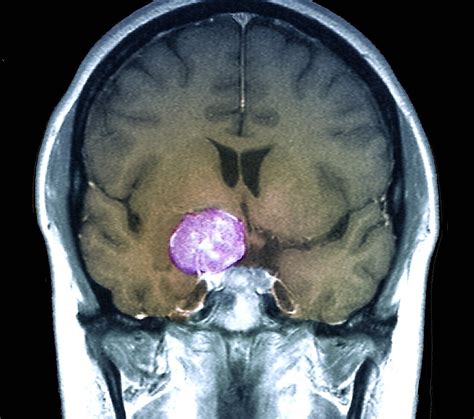 Meningioma Brain Tumour Mri Scan Bild Kaufen 12919130 Science