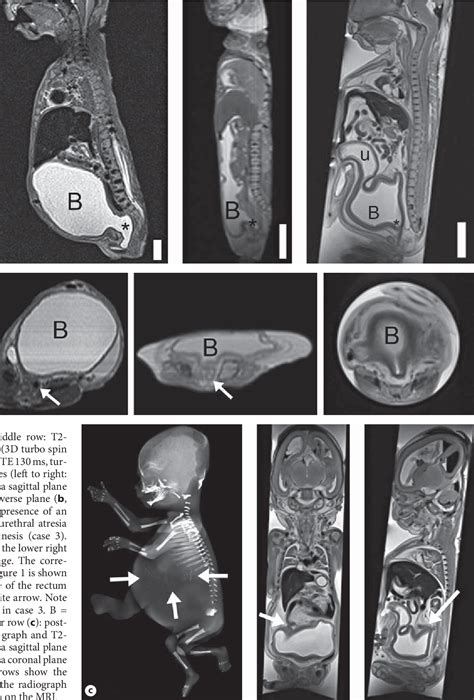 Figure From Postmortem High Resolution Fetal Magnetic Resonance