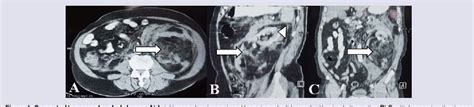 Figure 1 From Spontaneous Perinephric Haemorrhage Wunderlich Syndrome