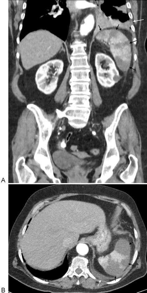 Coronal A And Axial B Contrast Enhanced Abdominal Computed