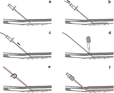 A Step By Step Scheme Of The Seldinger Technique The Needle Puncturing