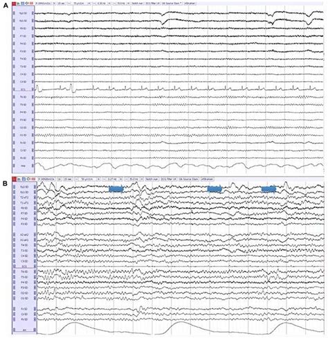 Frontiers Eeg Characteristics Of Dementia With Lewy Bodies Alzheimer