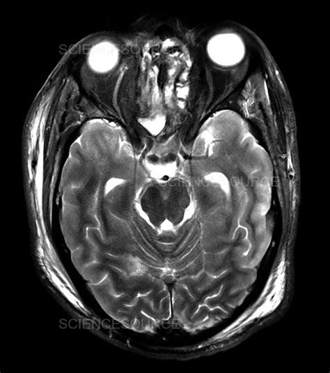 Photograph | Traumatic Brain Injury MRI | Science Source Images