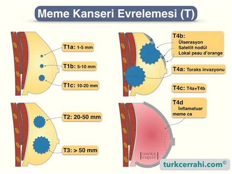 Meme Kanserinde TNM Evrelemesi Turkcerrahi