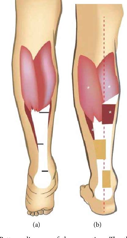 Figure From Modified Percutaneous Achilles Tendon Lengthening By