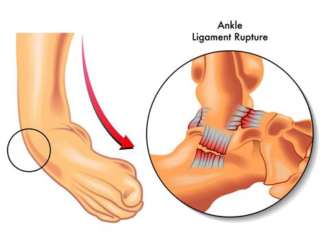 Lateral Ankle Sprain Motus Physical Therapy