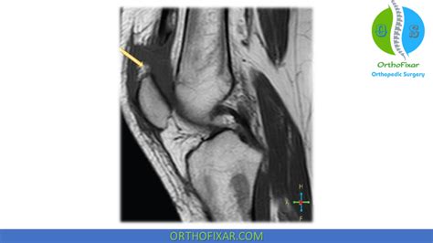 Quadriceps Tendon Rupture | OrthoFixar 2024